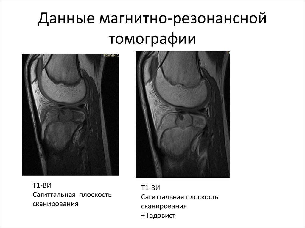 Локальный гипертонус по передней стенке