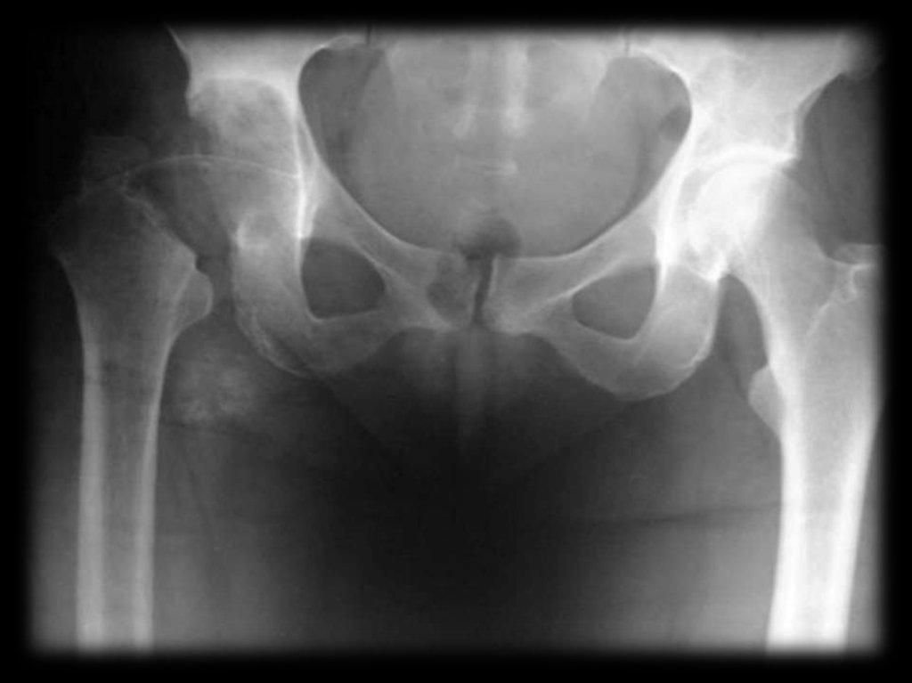 Патология тазобедренного сустава. Коксит тазобедренного сустава рентген. Что такое остеомиелит кости тазобедренного сустава. Туберкулез тазобедренных суставов рентгенограммы.