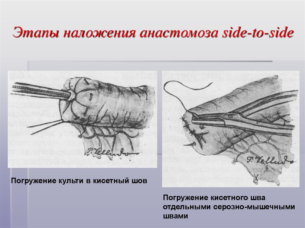 Кишечные швы. Кисетный шов топографическая анатомия. Стерильный непрерывный серозно-мышечный кисетный шов. Кисетный шов (шов Дуайена).