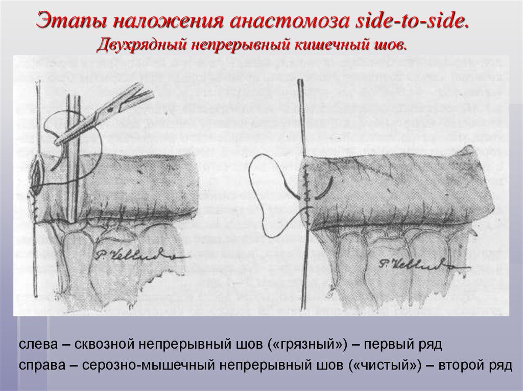 Анастомоз по брауну схема