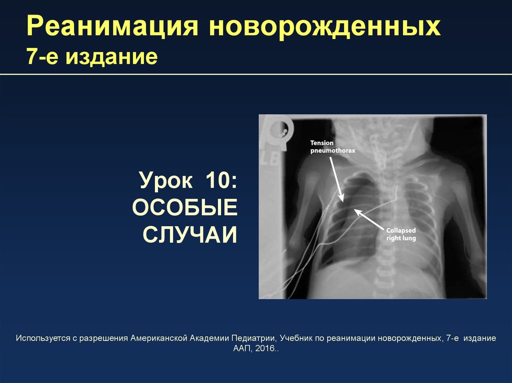 Реанимация новорожденного презентация