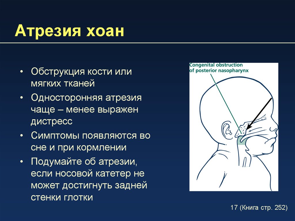 Атрезия это. Атрезия (заращение) носовых ходов. Двусторонняя атрезия Хоан. Врожденная атрезия Хоан.