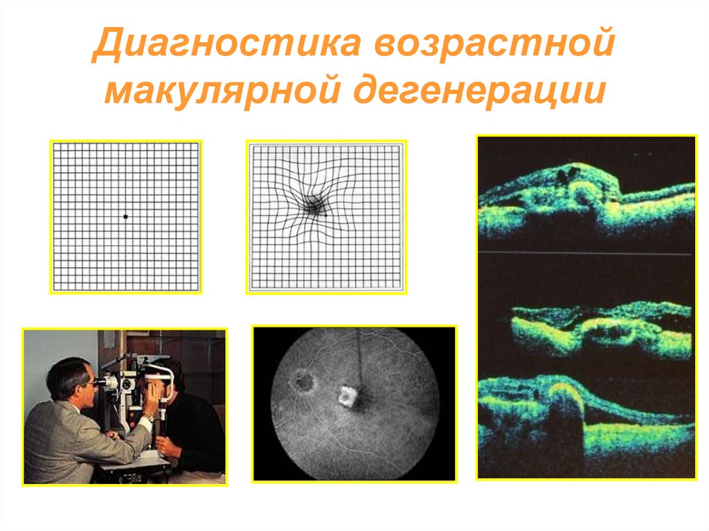 Возрастная макулярная дегенерация презентация