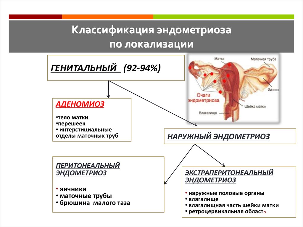Норма эндометриоза. Классификация наружного генитального эндометриоза. Клинические симптомы эндометриоза. Классификация эндометриоза по локализации. Внутренний генитальный эндометриоз клиника.
