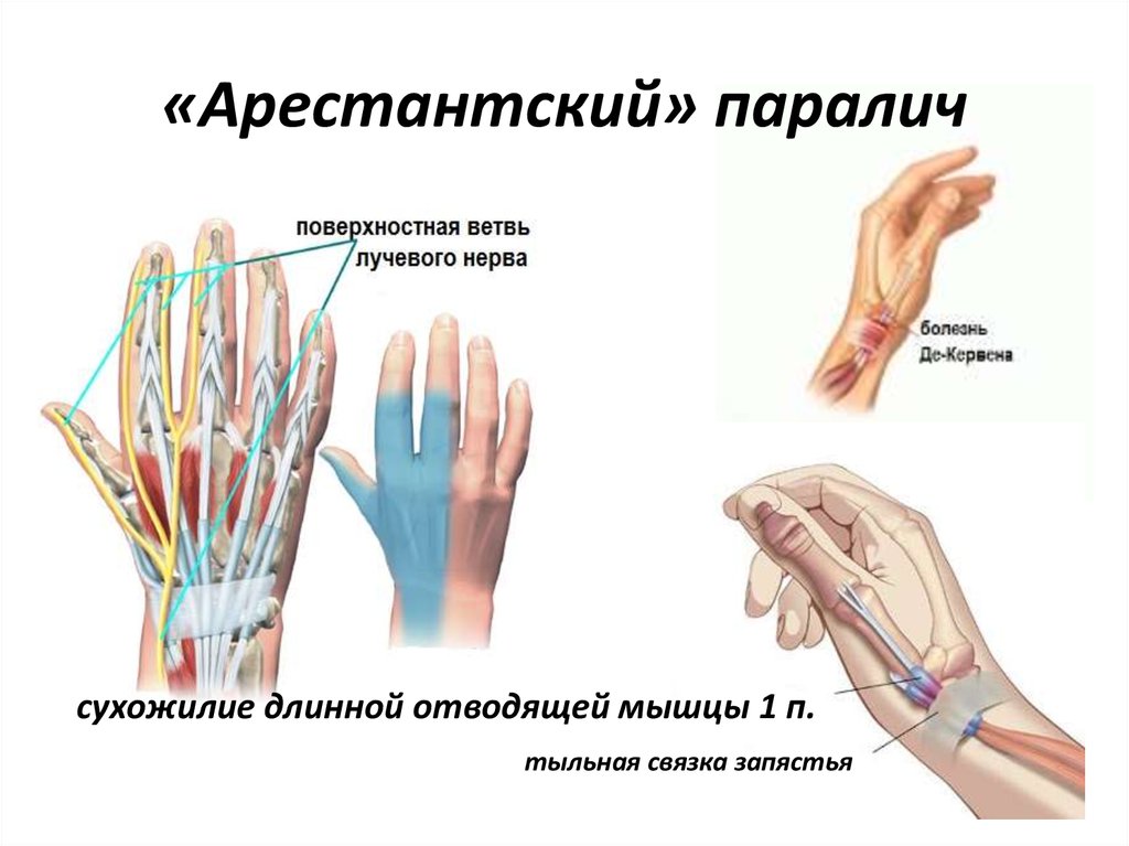 Невропатия верхних конечностей. Ветви поверхностной ветви лучевого нерва. Нейропатия поверхностной ветви лучевого нерва. Арестантский паралич лучевого нерва. Поверхностная ветвь лучевого нерва на тыле кисти.