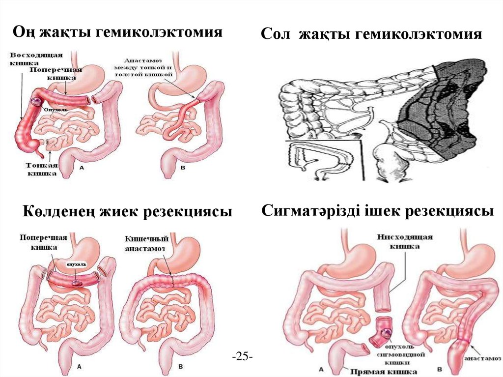 Операция лахея схема