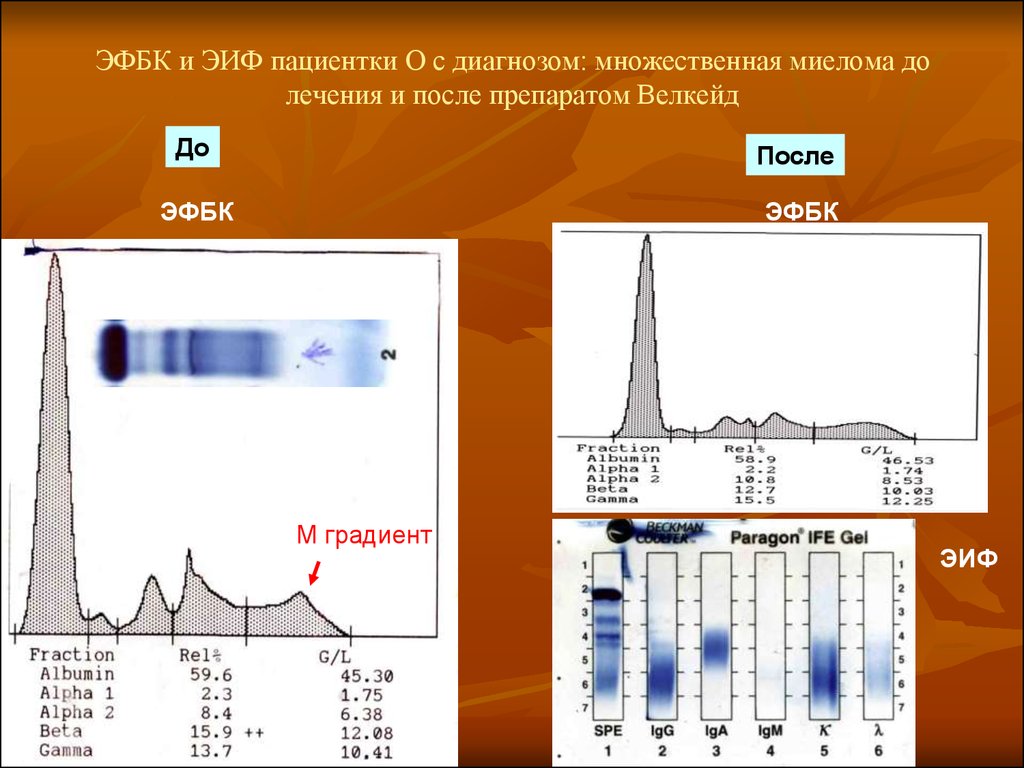 М градиент. Белковые фракции при миеломной болезни. Электрофорез белков при миеломе. Миеломная болезнь электрофорез. Электрофорез белков при миеломной болезни.