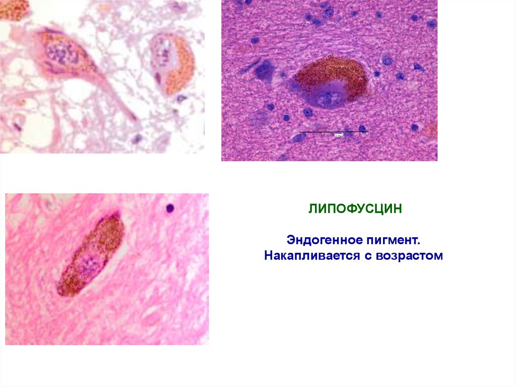 Липофусциноз. Липофусцин гистология. Липидогенные пигменты липофусцин. Липофусцин это патанатомия. Липидогенные пигменты патанатомия.