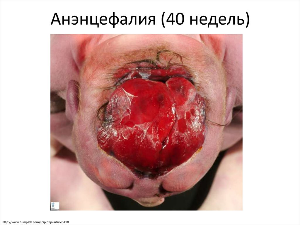 Анэнцефалия (40 недель)