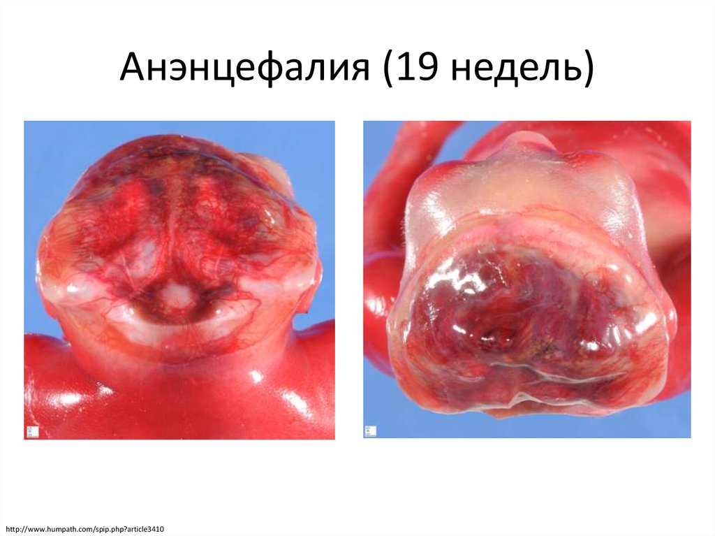 Анэнцефалия (19 недель)