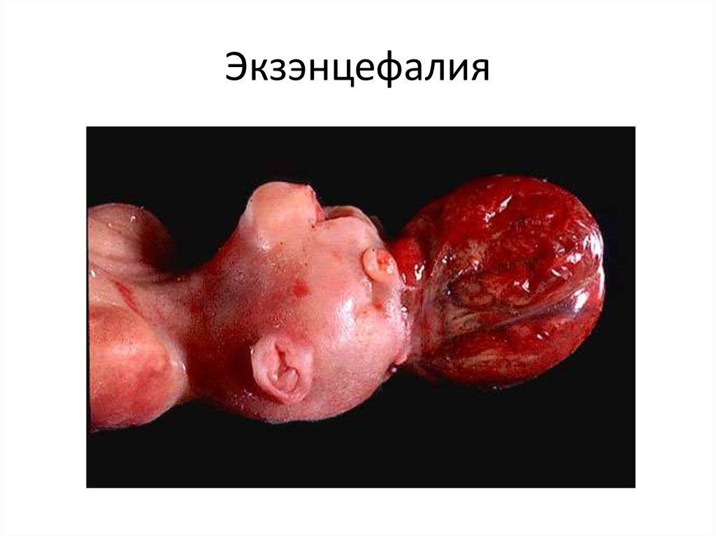 Экзэнцефалия