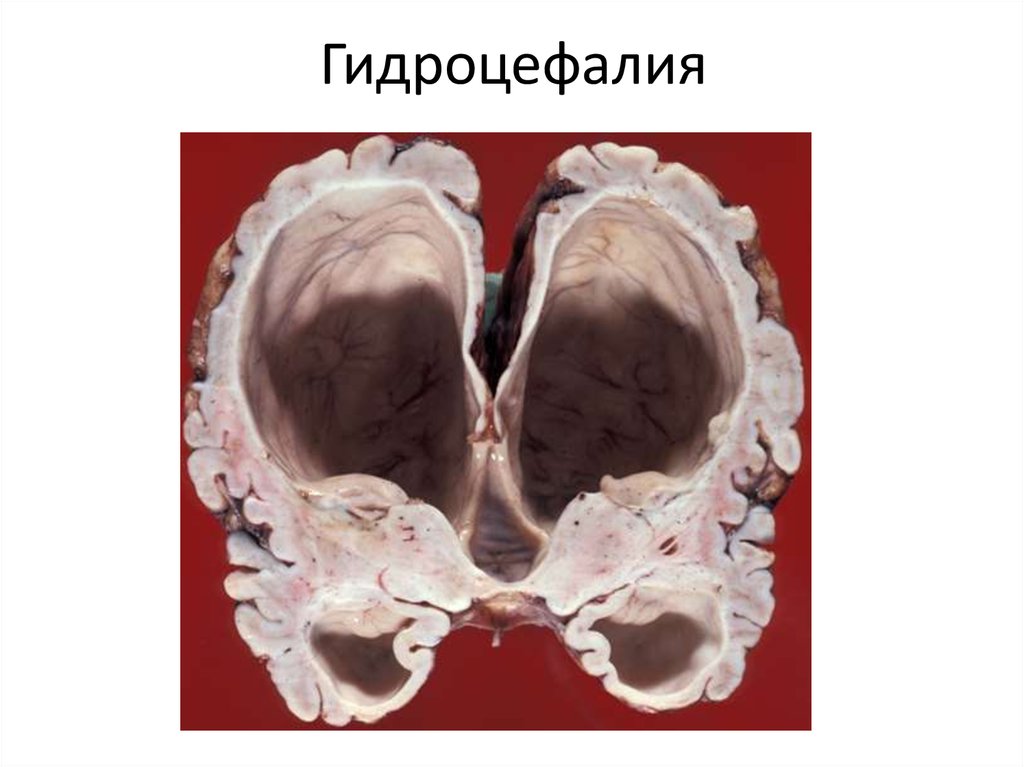 Гидроцефалия