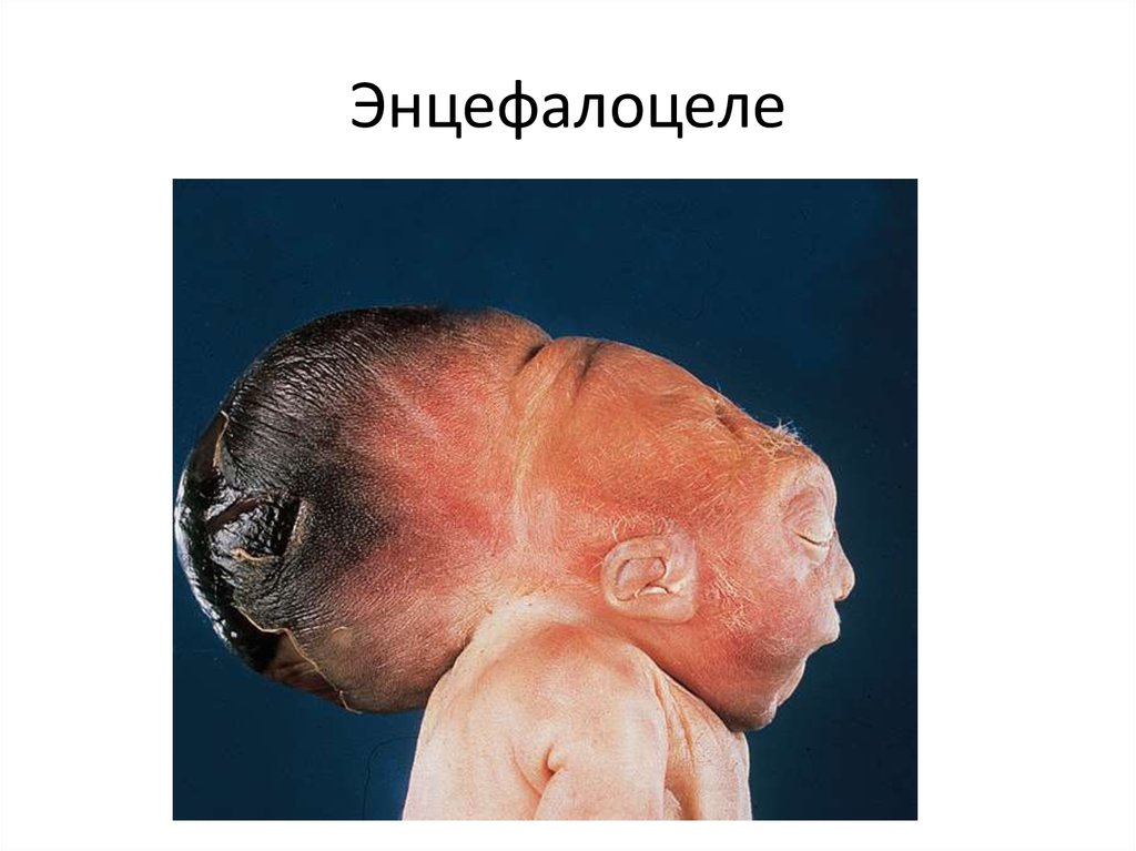 Энцефалоцеле