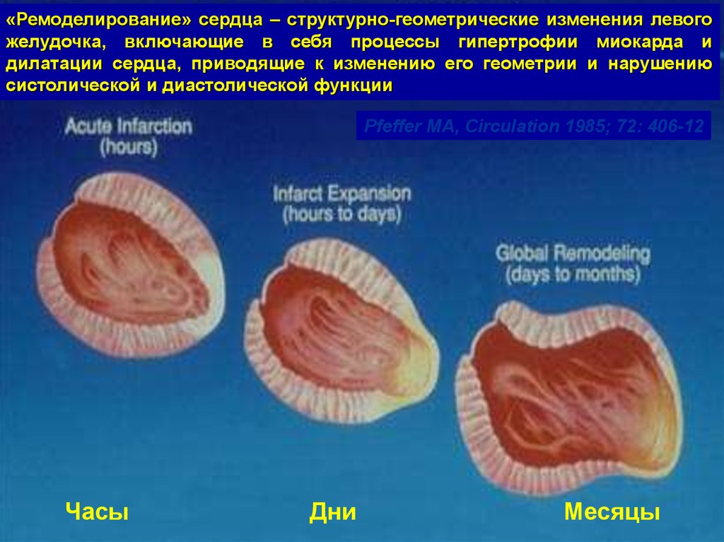 Левый желудочек изменения. Патогенез ремоделирования миокарда. Концентрическое ремоделирование левого желудочка сердца. Патогенез ремоделирования сердца. Типы ремоделирования миокарда.