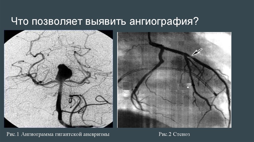 Ангиография: общие принципы - презентация онлайн