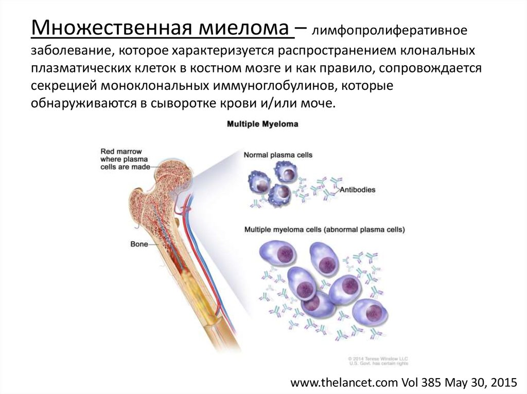 Множественная миелома картинки