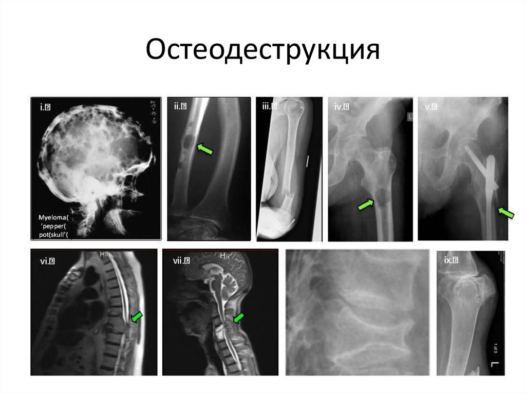 Болезнь рентген. Миеломная болезнь поражение костей рентген. Миеломная болезнь кт кости. Миеломная болезнь рентген позвоночника. Миеломная болезнь кости рентген.