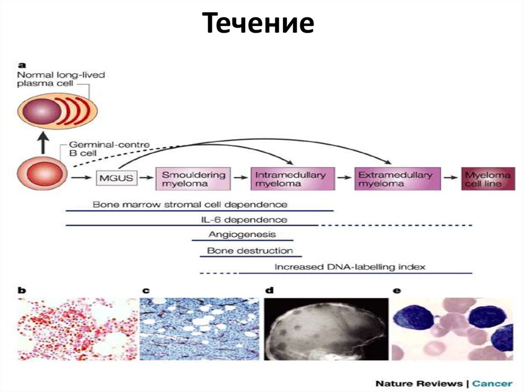 Патогенез множественной миеломы схема