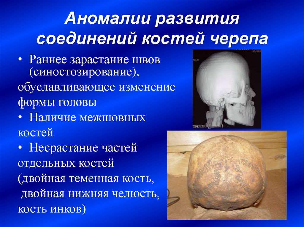 Аномалии развития. Аномалии развития черепа. Аномалии костей черепа. Аномальные формы черепа.