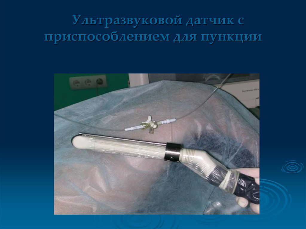 Пункция яичников при эко. Пункция фолликулов яичников. Трансвагинальная пункция.