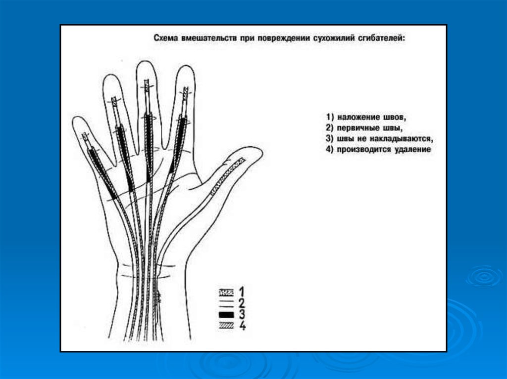 Диагностика повреждения сухожилий. Зоны сухожилий сгибателей кисти. Зоны повреждения сухожилий сгибателей. Оперативные вмешательства при повреждениях сухожилий. Уровни повреждения сухожилий.