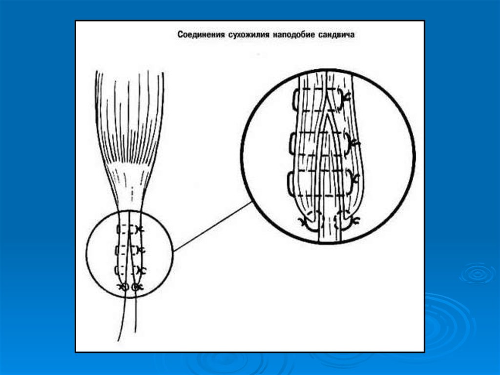 Операции на нервах сухожилиях. Шов сухожилия топографическая анатомия. Типы сухожильных швов. Гофрирующий шов сухожилия.