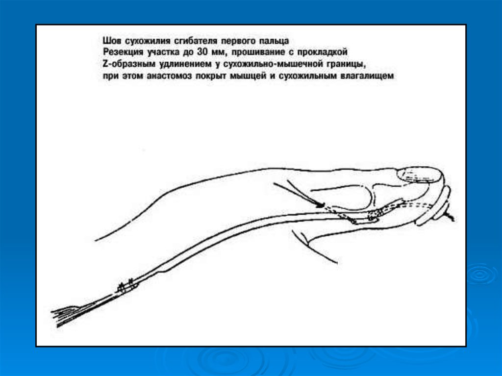 Операции на нервах сухожилиях. Шов сухожилия сгибателя. Шов сухожилия разгибателя пальца. Шов сухожилия сгибателей пальцев кисти. Шов сухожилия сгибателя первого пальца.