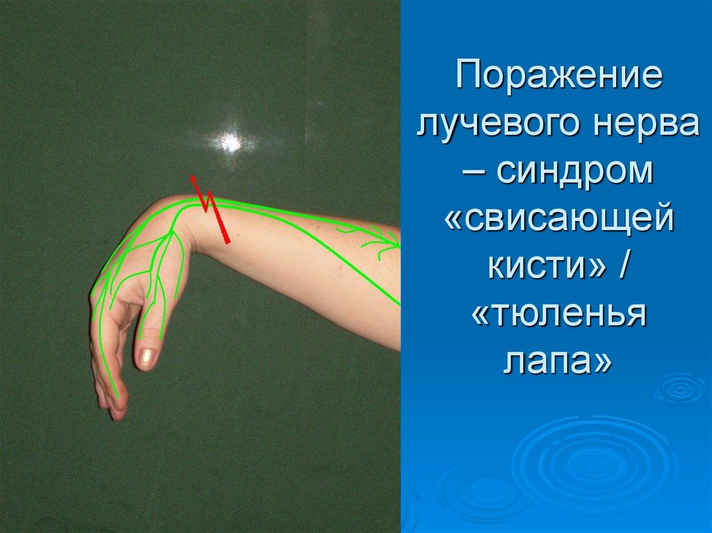 Невропатия нерва руки