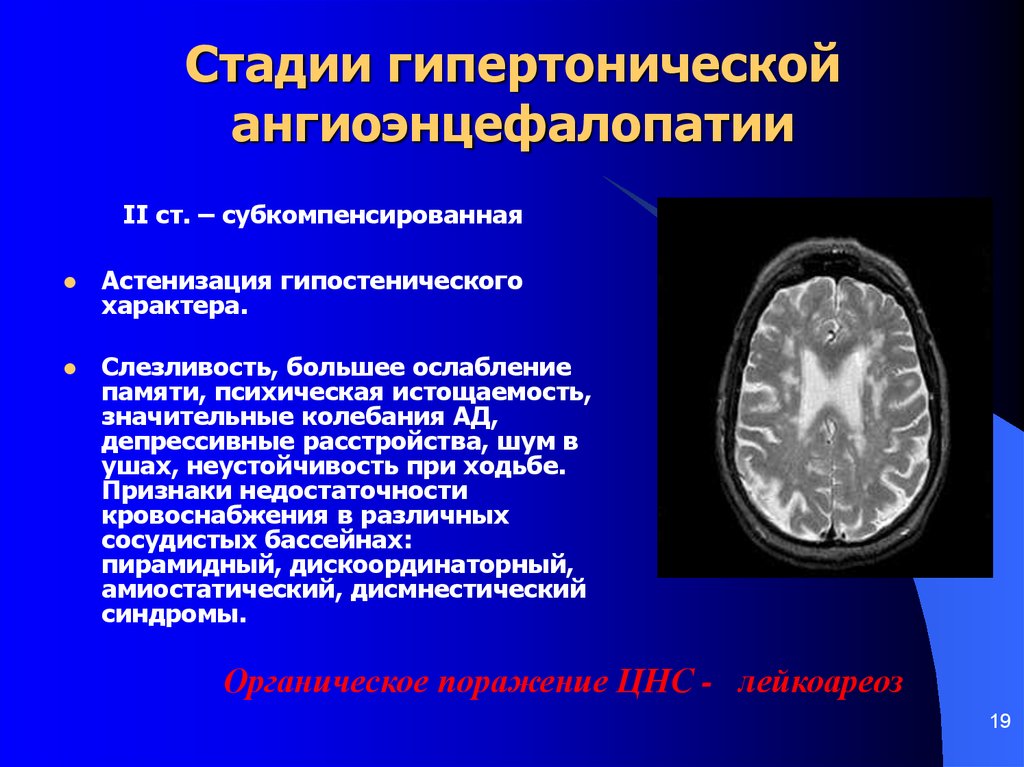 Изменение вещества мозга дистрофического дисциркуляторного характера. Гипертоническая мультиинфарктная энцефалопатия мрт. Ангиоэнцефалопатия головного мозга симптомы. Гипертоническая ангиоэнцефалопати. Ангеоцелопатия головного мозга.