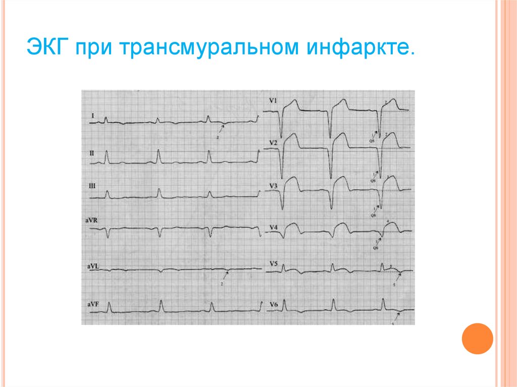 Трансмуральный инфаркт миокарда. Острый передний трансмуральный инфаркт ЭКГ. ЭКГ при трансмуральном инфаркте миокарда. Острый трансмуральный инфаркт передней стенки на ЭКГ. Острая стадия трансмурального инфаркта миокарда ЭКГ.