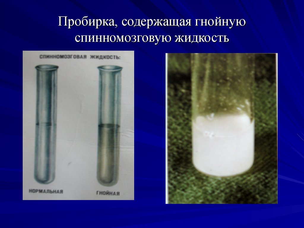 Спинная жидкость. СМЖ В пробирке. Спинномозговая жидкость в пробирке. Опалесцирующая спинномозговая жидкость. Спинномозговая жидкость как выглядит.