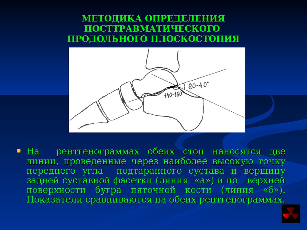 Углы стопы. Измерение продольного плоскостопия на рентгенограмме. Измерение угла плоскостопия. Измерение продольного плоскостопия на рентгене. Плоскостопие в рентгенологии.