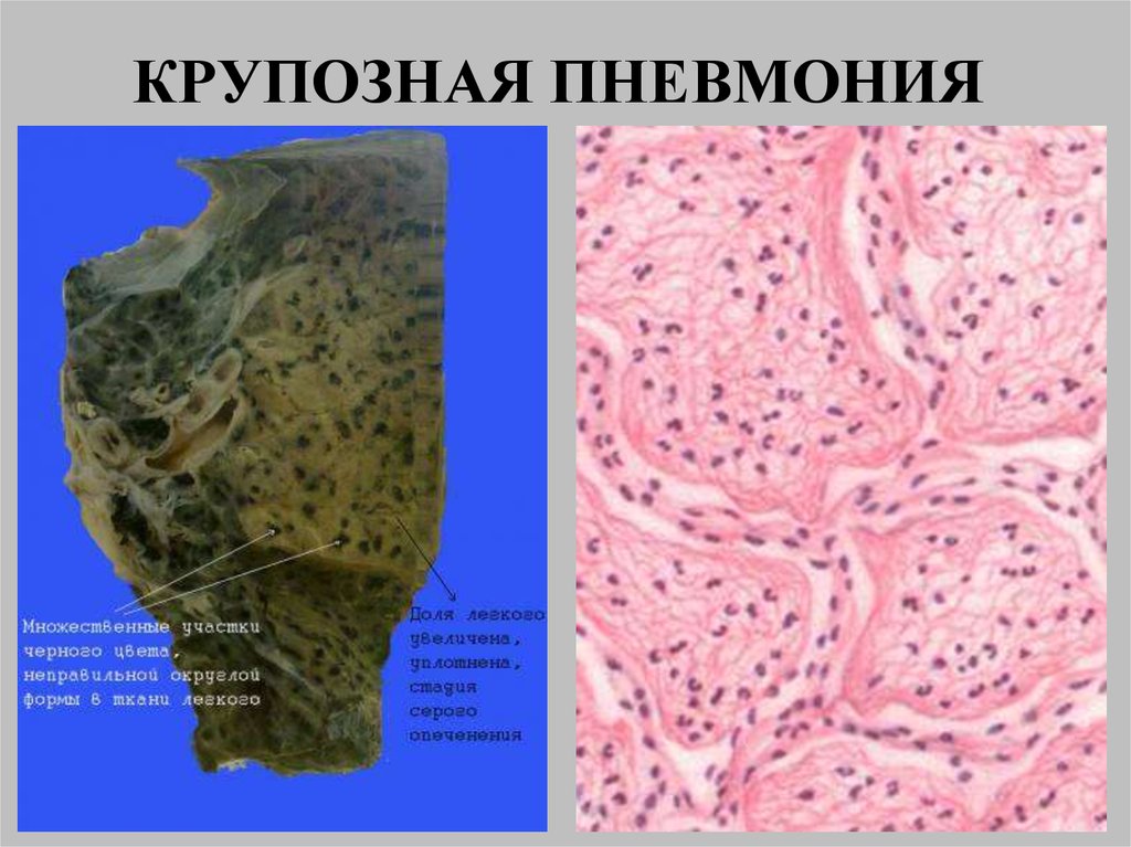 Крупозная пневмония. Стадии крупозной пневмонии патанатомия. Пневмония патанатомия макропрепарат. Крупозная пневмония патанатомия стадия прилива. Крупозная пневмония макропрепарат.