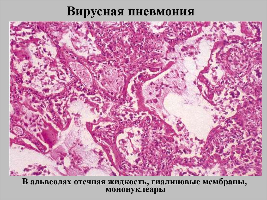 Вирус пневмонии. Межуточная пневмония гистология. Болезнь гиалиновых мембран микропрепарат. Интерстициальная пневмония микропрепарат. Гиалиновые мембраны микропрепарат.