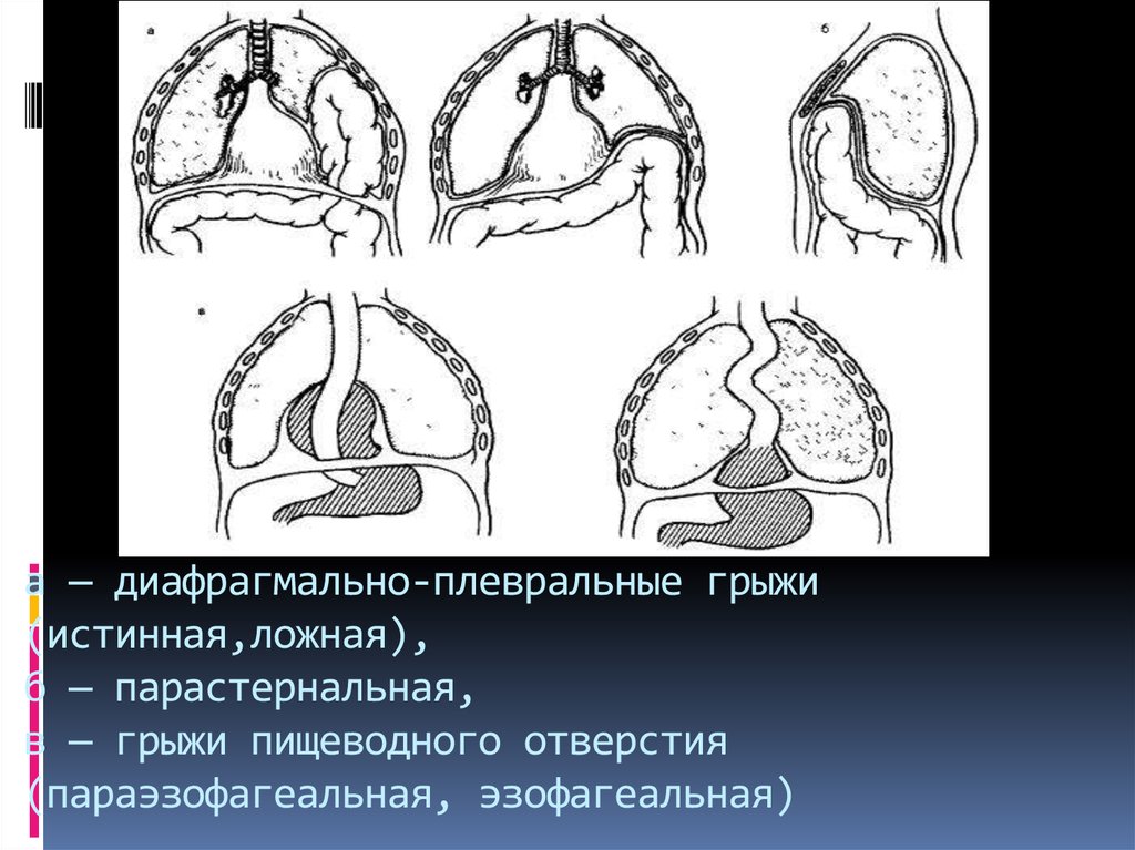 Диафрагмальная грыжа. Врожденная ложная диафрагмальная грыжа. Левосторонняя диафрагмальная грыжа. Истинная диафрагмальная грыжа. Ложные врожденные грыжи диафрагмы.