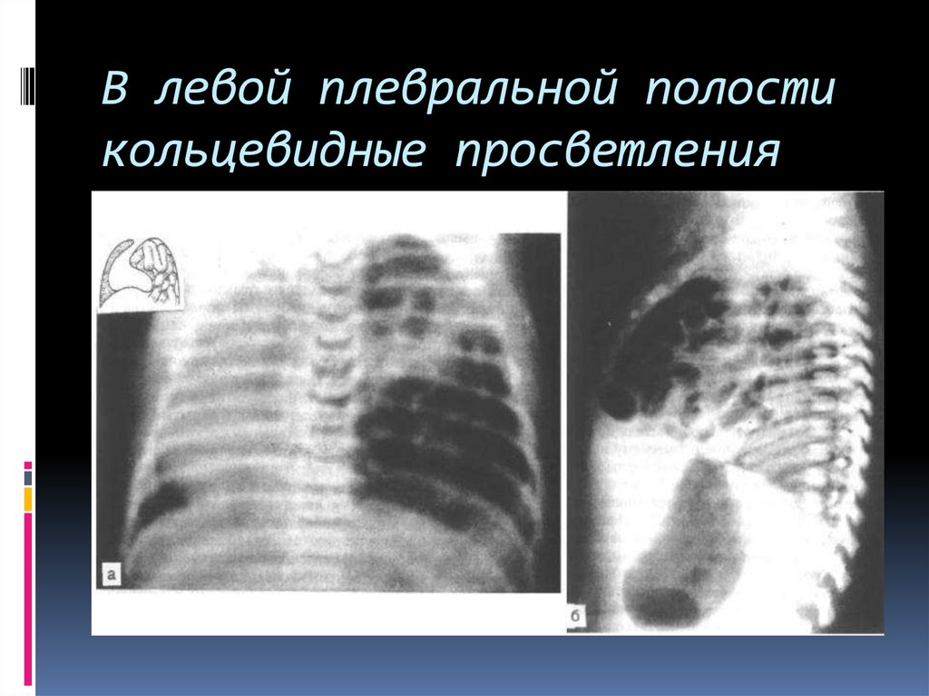 Диафрагмальная грыжа клиническая картина