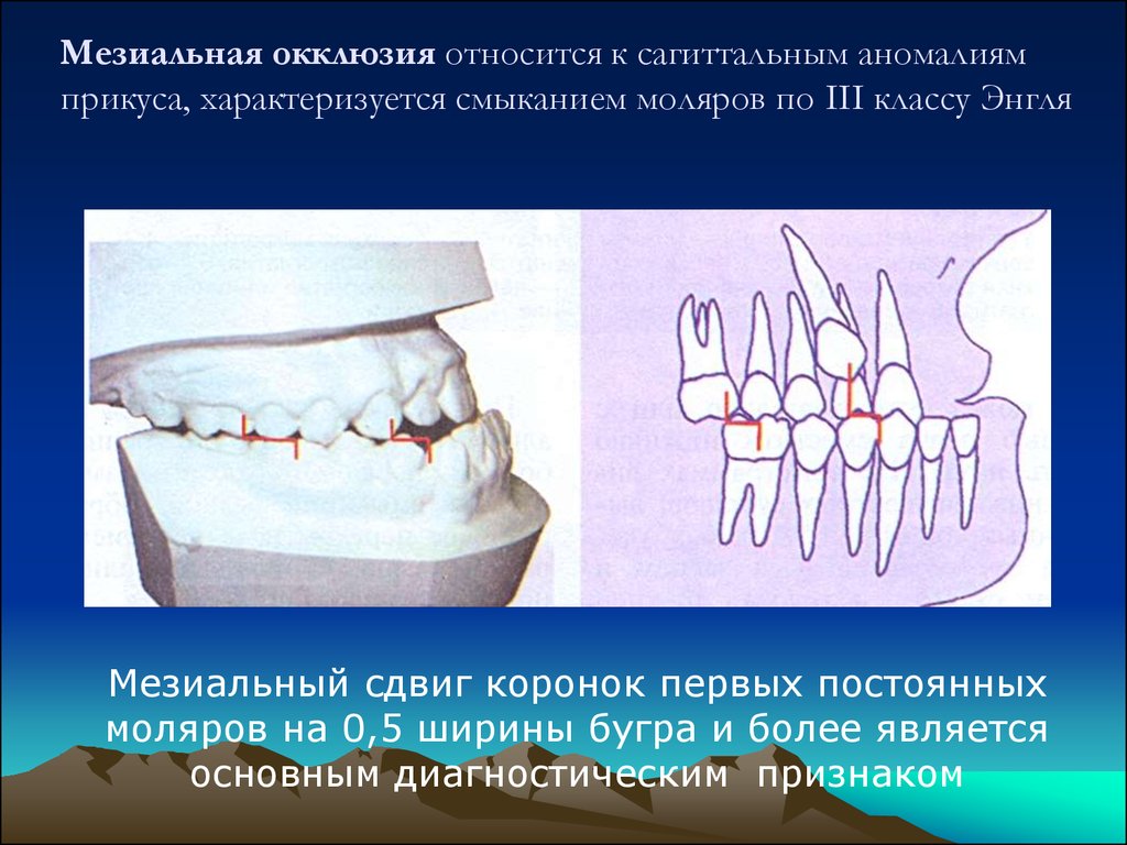 Классы окклюзии. Дистальная и мезиальная окклюзия. Прикус прогенический мезиальный. Мезиальная окклюзия класс по Энглю. Аномалия прикуса отклонение.