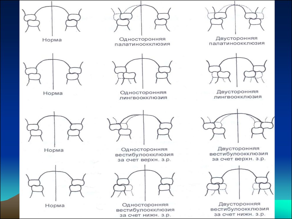 Перекрестный. Перекрестный прикус классификации перекрестного прикуса. Классификация перекрестной окклюзии. Классификация перекрестного прикуса по Персину. Перекрестный прикус классификация Персин.