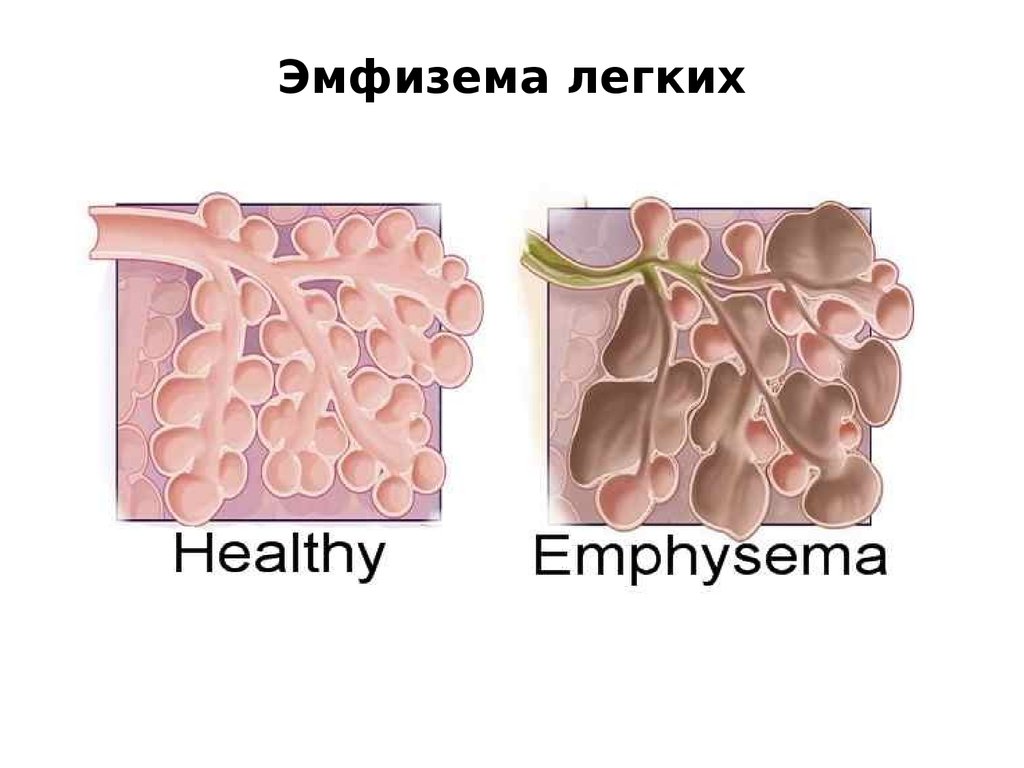 Эмфизема легких. Вторичная эмфизема легких. Локальная эмфизема легких.