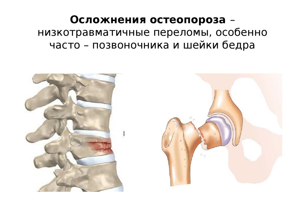 Осложнения при открытых переломах. Перелом шейки бедренной кости компрессионный. Остеопороз перелом позвонка. Остеофиброз шейки бедра. Перелом шейки бедра остеопороз.