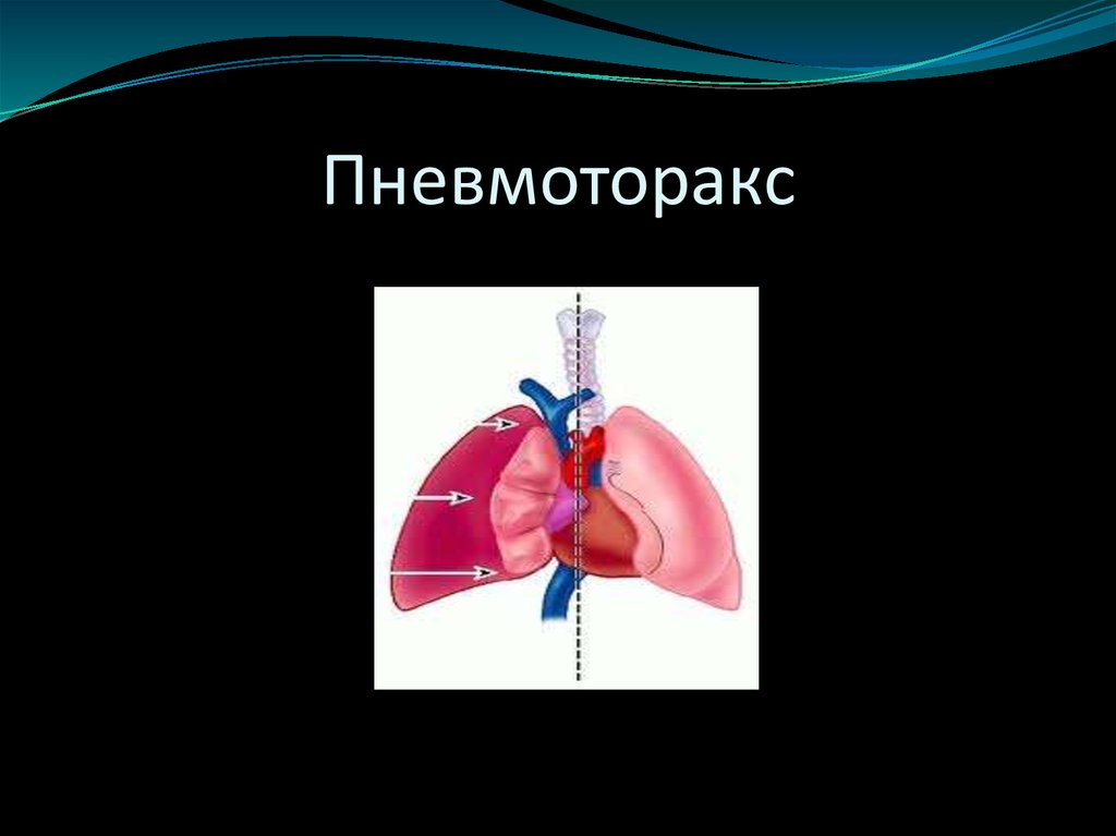 Закрытый пневмоторакс это