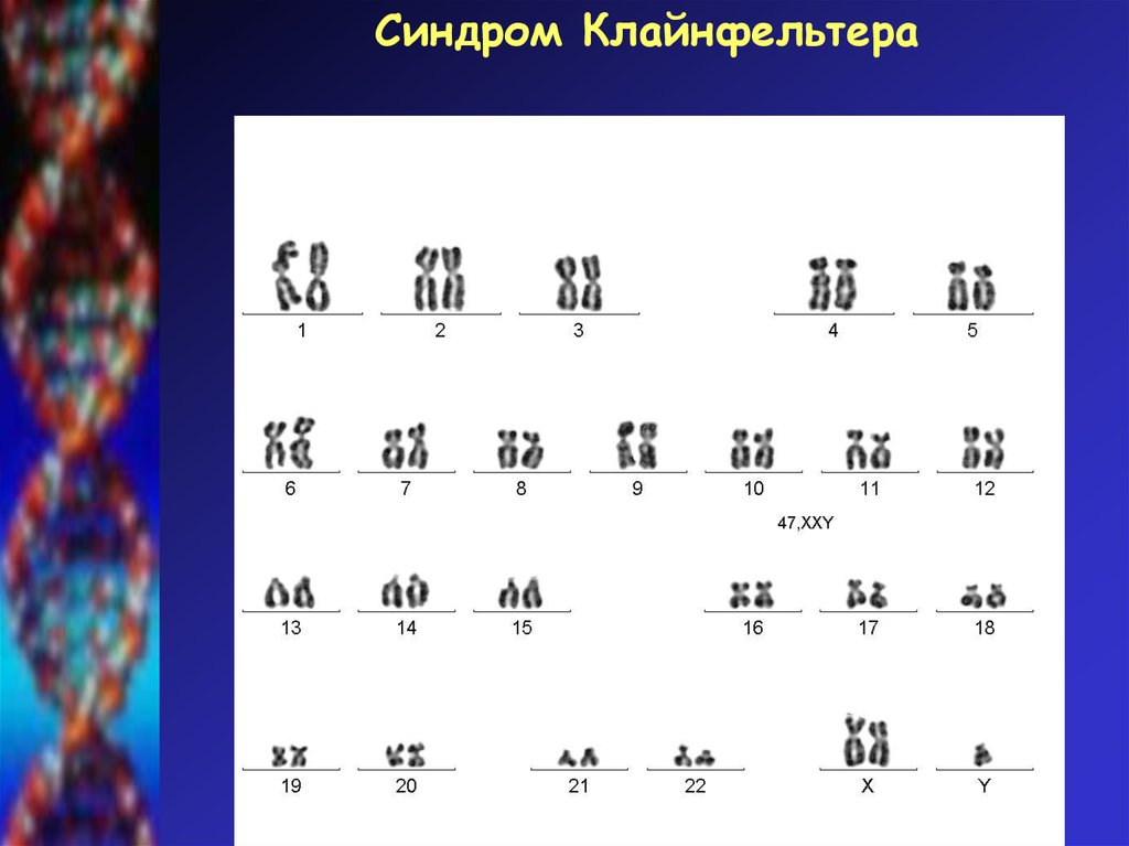 Синдром клайнфельтера фото. Xxy синдром Клайнфельтера кариотип 47. Хромосомные аномалии синдром Клайнфельтера. Хромосомный набор человека, страдающего синдромом Клайнфельтера. Гаметогенез синдром Клайнфельтера.