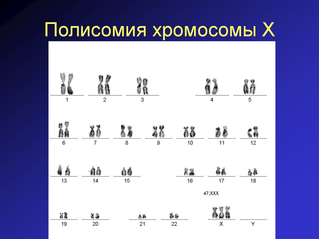 50 chromosome. Синдром полисомия по х-хромосоме. Синдром полисомии х-хромосомы кариотип. Полисомия по y-хромосоме синдром. Синдром полисомии по х-хромосоме кариотип.