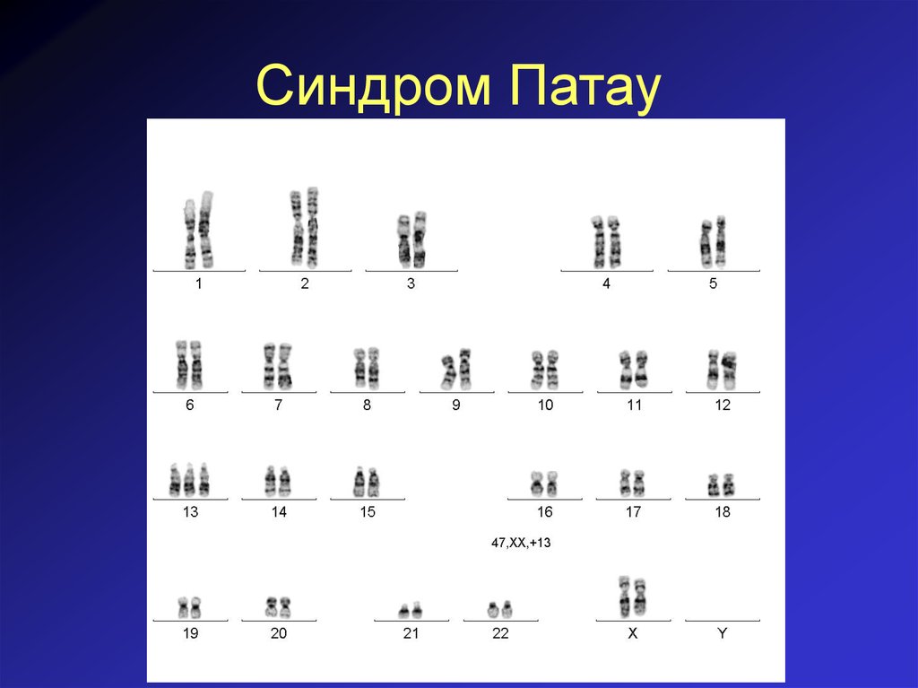 Аномалия хромосом. Синдром Патау формула кариотипа. Синдром Патау робертсоновская транслокация. Идиограмма синдрома Патау. Синдром Патау кариотип.