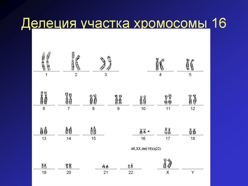 Кольцевая 4 хромосома. Делеция хромосомы. Делеция участка хромосомы 16. Частичная делеция хромосомы.