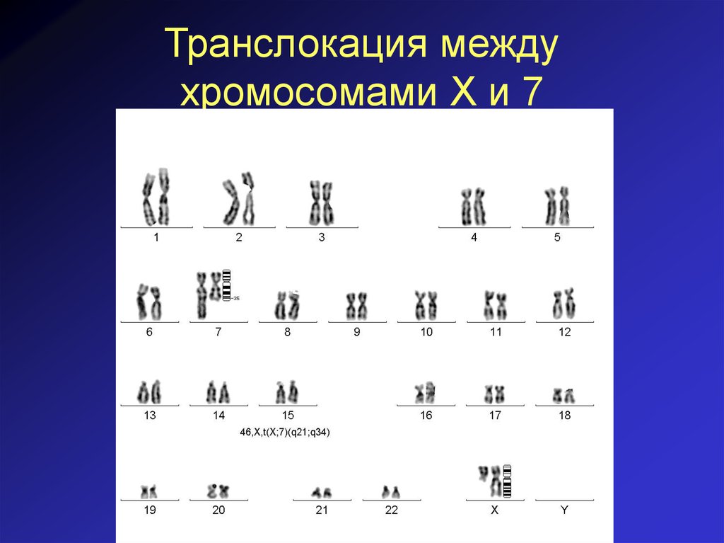 Транслокация хромосом фото