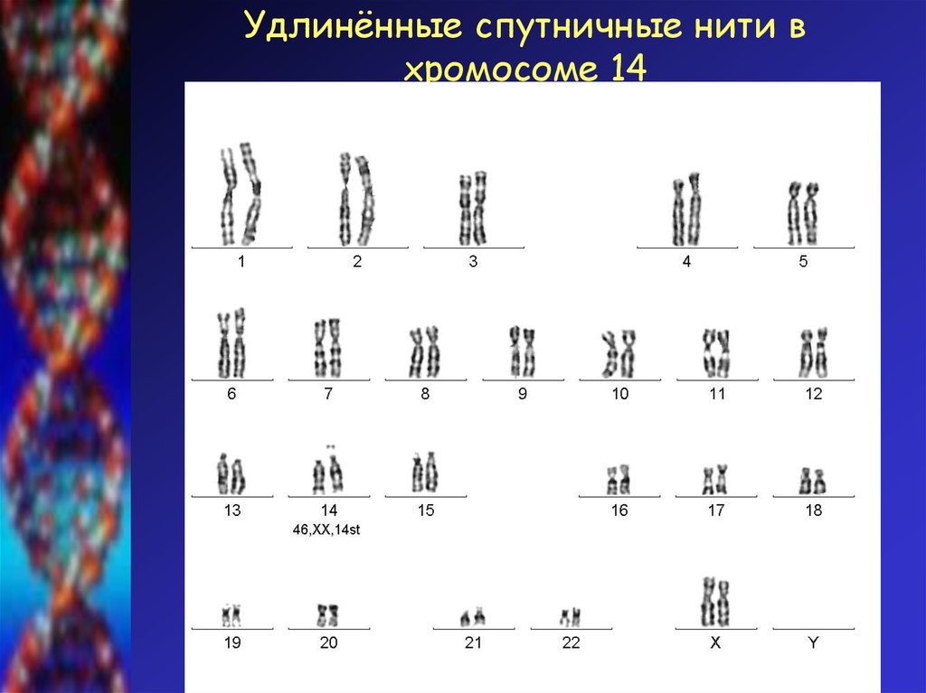 Нити хромосом. Удлиненные спутничные нити в хромосоме 14. Спутничная хромосома. Спутничные хромосомы в кариотипе человека. Хромосомная нить.