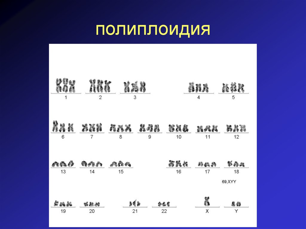 Кариограмма это. Полиплоидия. Полиплоидия кариограмма. Полиплоидия 2n+. Полиплоидия кардиограмма.