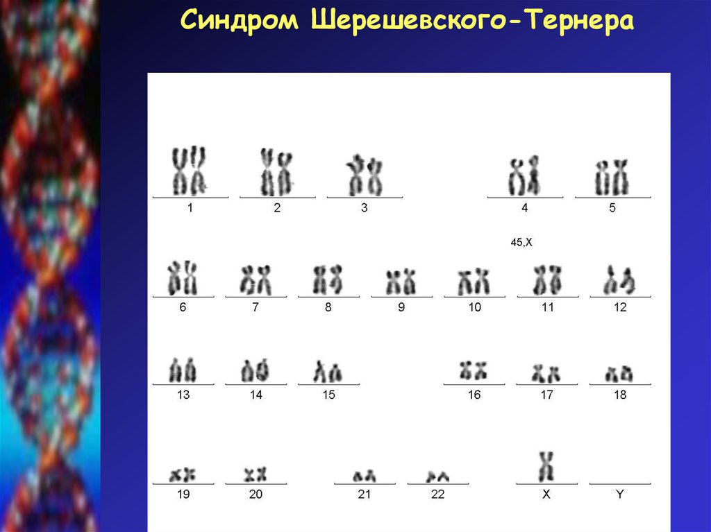 Синдром тернера какая хромосома. Синдром Шерешевского Тернера кариотип. Хромосомные аномалии синдром Шерешевского-Тернера. Синдром Шерешевского Тернера хромосомы. Формула кариотипа при синдроме Шерешевского-Тернера.