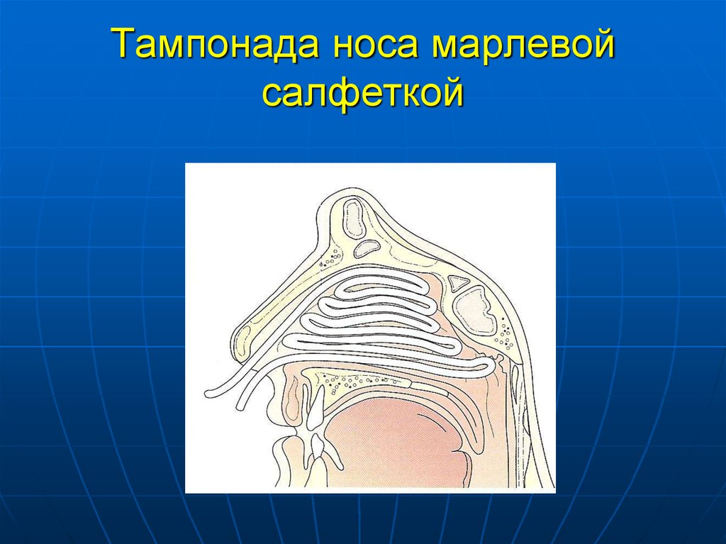 Тампонада. Рыхлая передняя тампонада. Передняя и задняя тампонада.